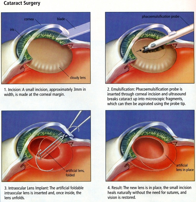 Super Eye Care Resources Educational Materials Patient Guides Dr Super Eye Care Resources Educational Materials Patient Guides Dr